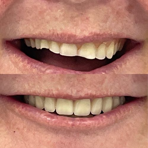 Before and after dentures — Case 2