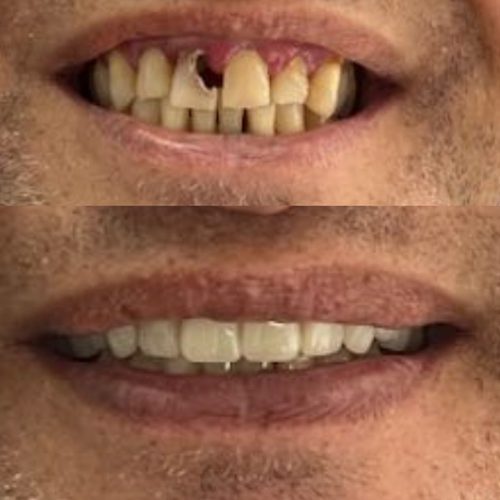 Before and after dentures — Case 5