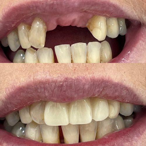 Before and after dentures — Case 6